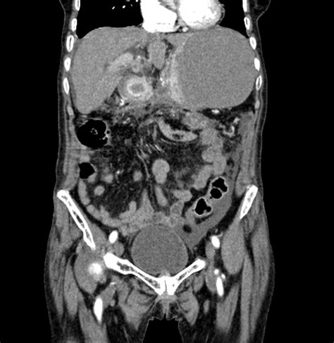 Gastro Duodenal Intussusception Image