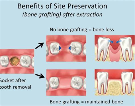 Post Op After Tooth Extraction And Bone Graft At Ramon Squires Blog