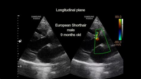 Ventricular Septal Defect Ultrasound