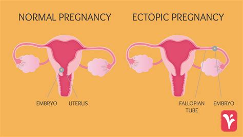 Ectopic Pregnancies: What You Need to Know - Austin Women's Health Center 