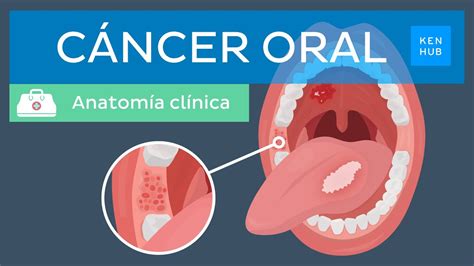 C Ncer Oral Definici N Factores De Riesgo Prevenci N Diagn Stico Y