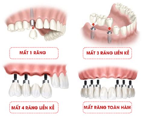 5 bước trong quy trình trồng răng implant chuẩn Y khoa 2024