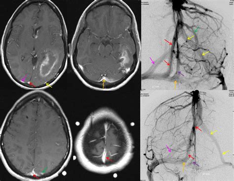 Intracranial Venous Sinus Stenosis