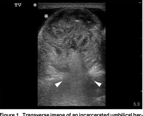 Ultrasound In Emergency Medicine Diagnosis And Reduction Of A Hernia By