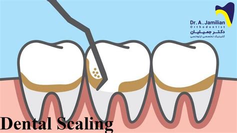 Dental Scaling Dr Jamilian