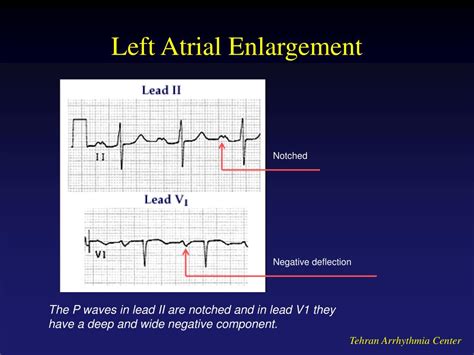 Ppt Electrocardiography Powerpoint Presentation Free Download Id 5026068