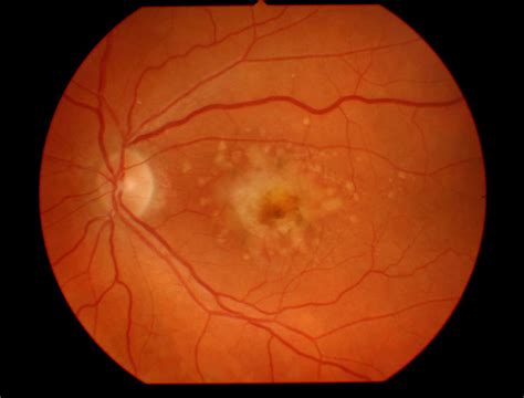 Degeneraci N Macular Asociada A La Edad Oftalmolog A Avanzada