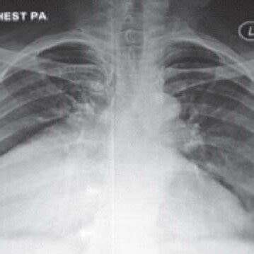 Chest Radiograph Postero Anterior View Showing A Right Sided