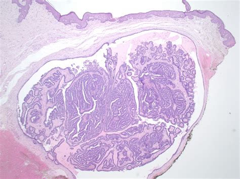 Hidradenoma Papilliferum Papillary Hidradenoma Mammary Like Gland