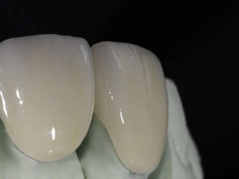 All Ceramic Restorations Triad Dental Studio