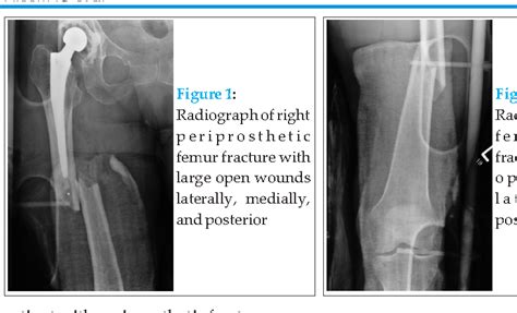 Figure From Early Definitive Fixation Of An Open Periprosthetic Femur