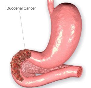 Duodenal Cancer Doctors in Perumbakkam NewGen Hospital