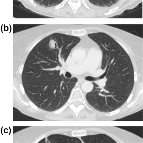 Chest Ct Scan On Day 9 Showed Rounded Infiltrates Measuring 2 3 Cm In