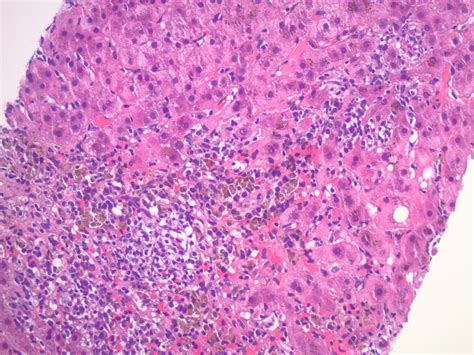 Pathology Outlines Acute Hepatitis General