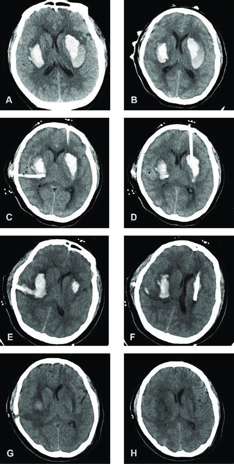 Non Contrast Head Ct Showing Bilateral Basal Ganglia Hemorrhages A