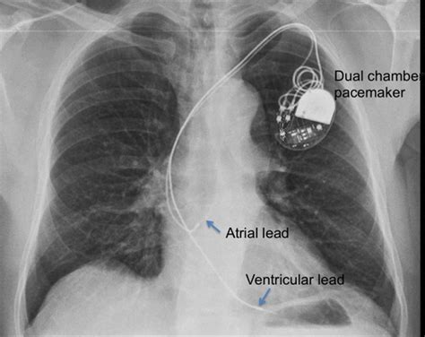 Dual Chamber Pacemaker Chest X Ray All About Cardiovascular System