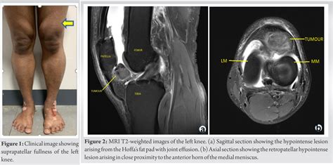 A Novel Technique Of Resecting Localized Pigmented Villonodular