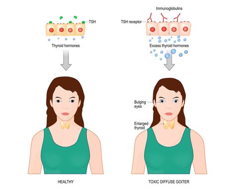 Thyroid Eye Disease (TED) - Santa Monica Eye Group