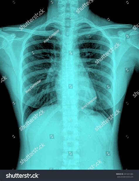 Xray Image Human Healthy Chest Mri Stock Photo Shutterstock