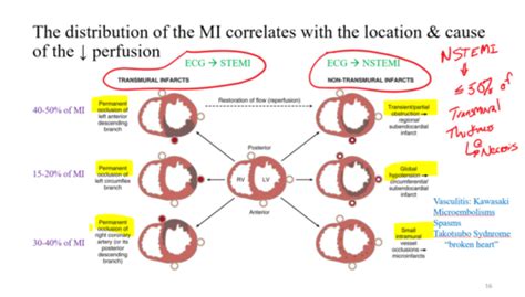 Myocardial Infarction: Pathogenesis & Types Flashcards | Quizlet