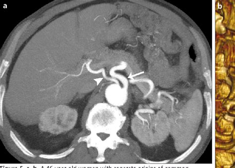 Celiac Artery Angiogram