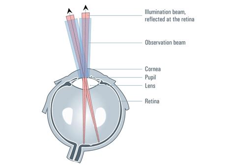 Red Reflex Cataract