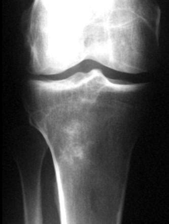 Chondrosarcoma Radiology Reference Article Radiopaedia Org