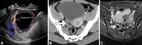 Benign Appearing Incidental Adnexal Cysts At Us Ct And Mri Putting