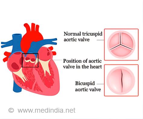 Bicuspid Aortic Valve