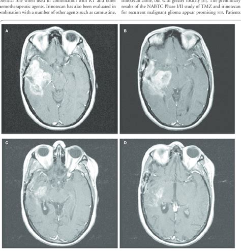 Axial T1 Weighted Contrast Enhanced Magnetic Resonance Images Of A