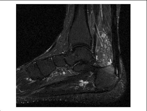 Sagittal Image From A T2 Series Magnetic Resonance Image Demonstrating