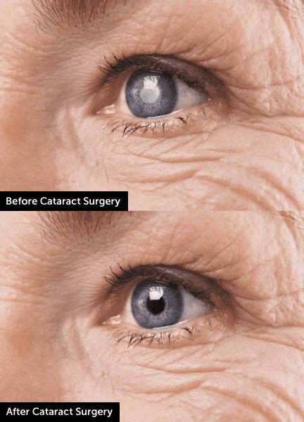 Cataract Eye Surgery In Iowa Wolfe Eye Clinic