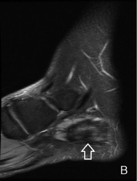 Foot Muscles Mri : Mri Lower Extremities Leg Cedars Sinai - Mri with hardware in foot? - decimo ...