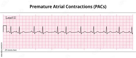 Premature Atrial Contractions Pacs Premature Atrial Complex Pac