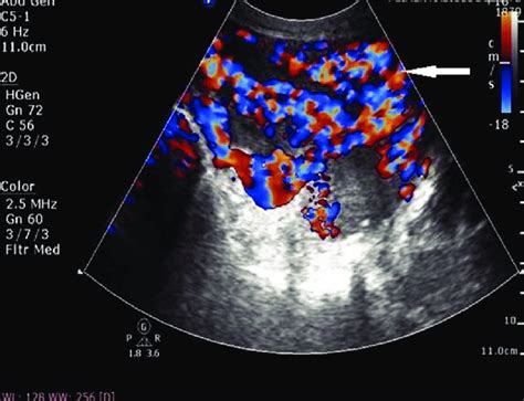 A 25‑year‑old Female With Uterine Arteriovenous Malformation Who