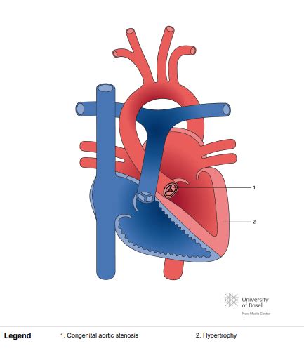 Congenital aortic stenosis - Perfusfind