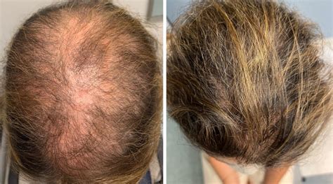 What Drug Causes Hair Loss