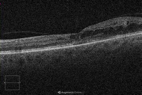 Diabetische Retinopathie Atlas Der Augenheilkunde