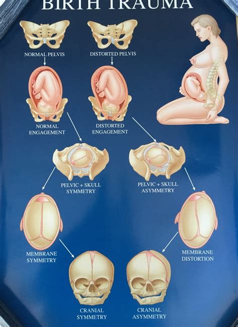 CCS Wall Chart: Birth Trauma | SORSI