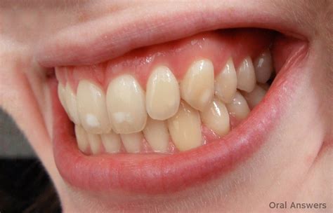 Dental Fluorosis Treatment: How Dental Fluorosis Is Treated | Oral Answers