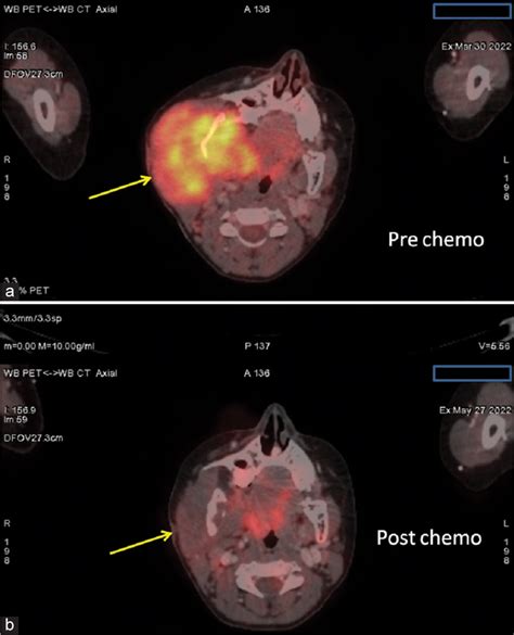 Myeloid Sarcoma Cases With Varied Presentations Leading To Diagnostic