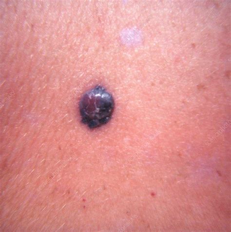 Skin Cancer Diagnosis And Treatment By Naomi Goldstraw Trusted Devon