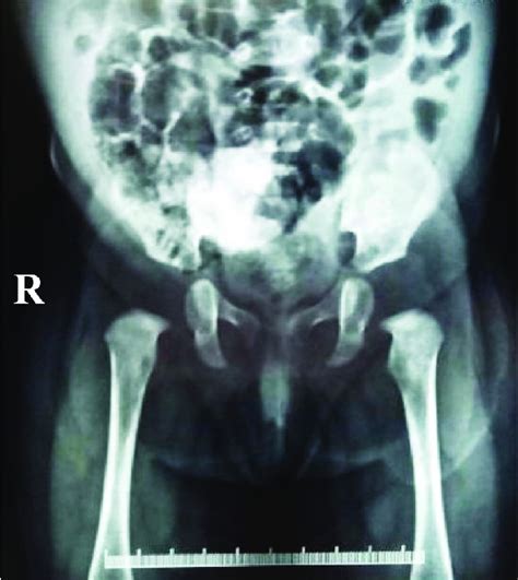 Cystogram (radiograph of the bladder with contrast, not properly ...