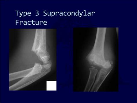 Ppt Pediatric Supracondylar Humerus Fracture Powerpoint Presentation