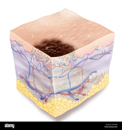 Melanoma Stage 0