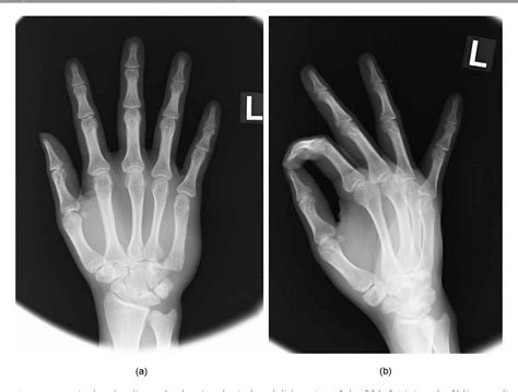 Figure 1 From Isolated Slipping Dislocation In The Ulnar Direction Of