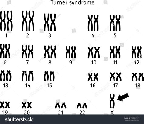 Scheme of Turner syndrome. karyotype of human - Royalty Free Stock Vector 1717349593 - Avopix.com