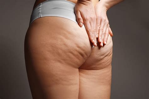 La Differenza Tra Cellulite E Ritenzione Idrica Schwabe Italia