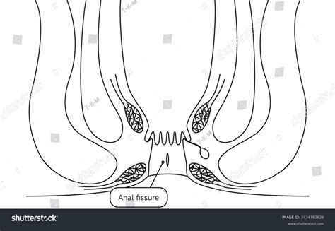 Diseases Anus Hemorrhoids Anal Fissures Illustration Stock Vector Royalty Free