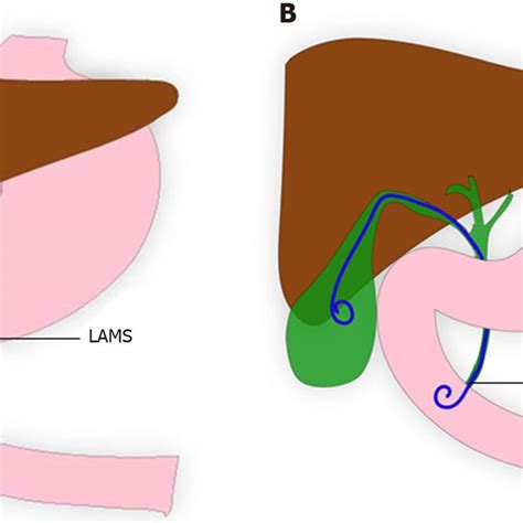 Types Of Lumen Apposing Metal Stents All Stent Images Available On